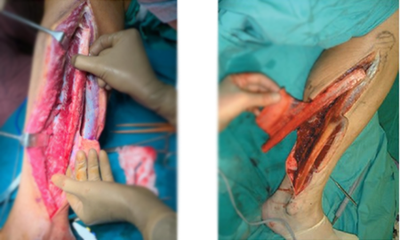 Jaw Bone Cancer Treatment in India